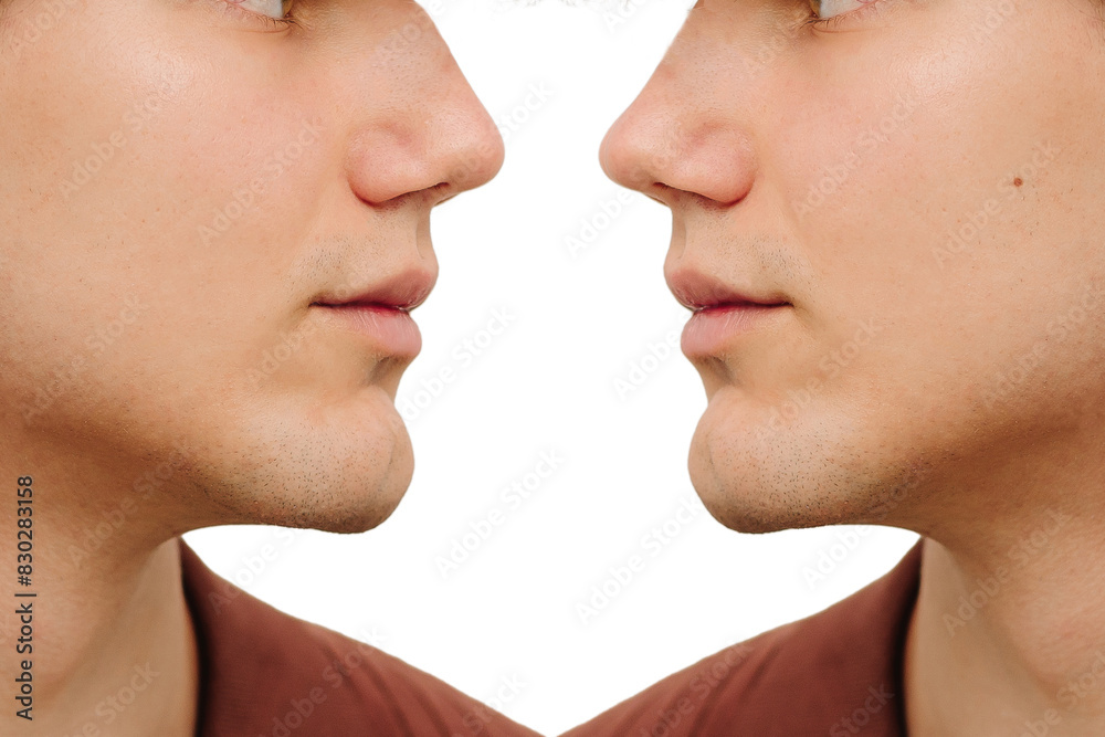 Obraz premium Before and after rhinoplasty surgery. Comparison rhinoplasty before plastic operation and result after to change shape of the nose. Septoplasty.
