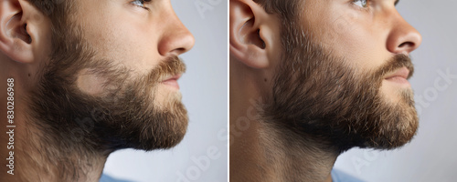 Collage of two photos of a man with a beard hair loss problem before and after treatment, anti-hair loss procedures, hair transplant, on a gray background, collage. Visit to a trichologist.