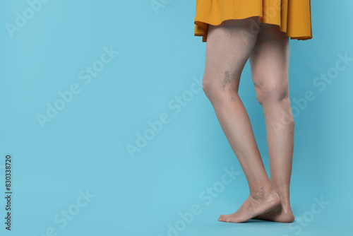 Closeup view of woman with varicose veins on light blue background. Space for text
