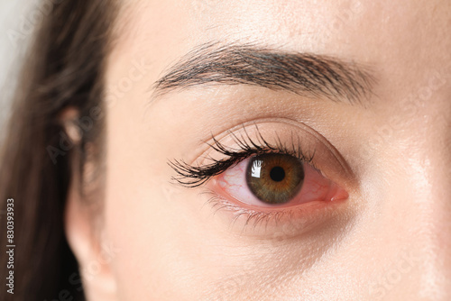 фотографія Woman with red eye suffering from conjunctivitis, closeup