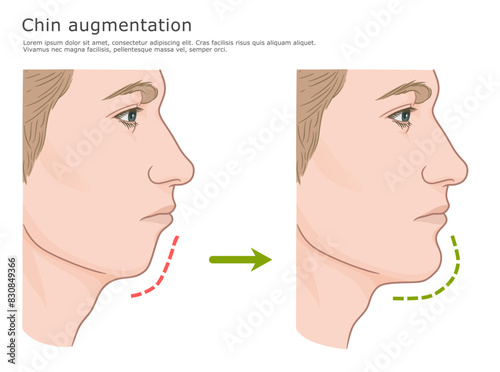 Chin augmentation surgery illustration. Contour of the chin area before and after. Plastic surgery medical illustration.