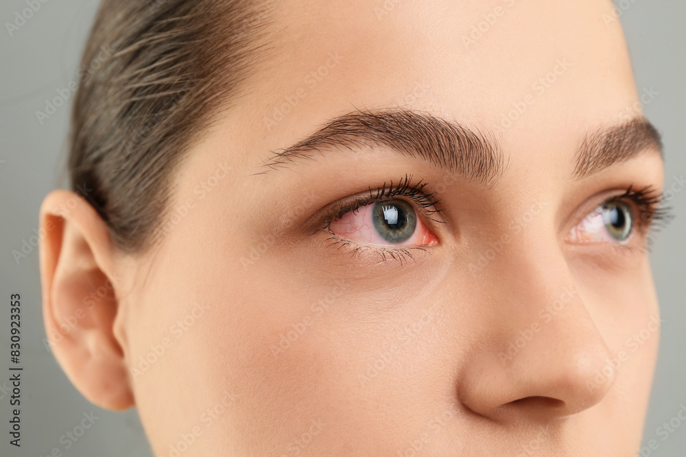 Woman with red eye suffering from conjunctivitis on grey background, closeup Woman with red eye suffering from conjunctivitis on grey background, closeup