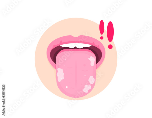 illustration of a tongue containing white spots. sticking her tongue out. symptoms of Leukoplakia, inflammation, fungal infection or candidiasis. diseases of the tongue or mouth. illustration design