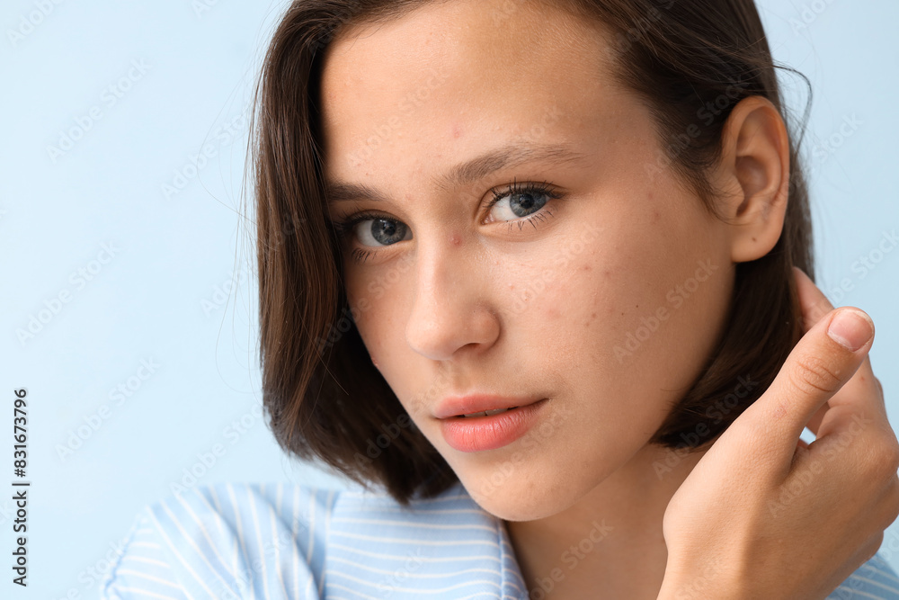 Beautiful young woman with acne problem on blue background Beautiful young woman with acne problem on blue background