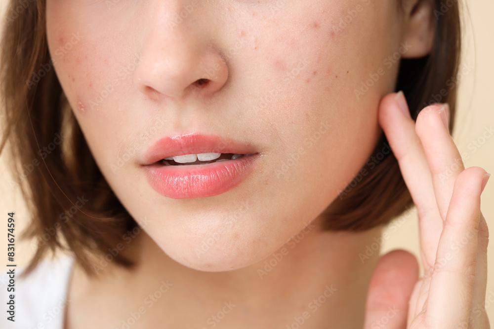 Beautiful young woman with acne problem on beige background, closeup Beautiful young woman with acne problem on beige background, closeup