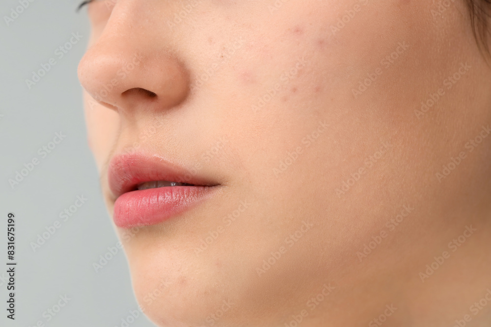 Beautiful young woman with acne problem on grey background, closeup Beautiful young woman with acne problem on grey background, closeup
