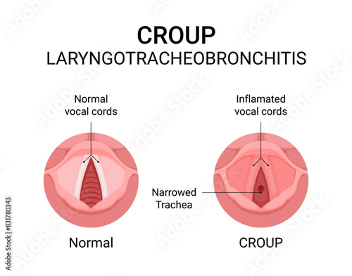 Diagram of Croup Laryngotracheobronchitis photo