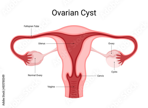 Symptoms of ruptured ovarian cyst