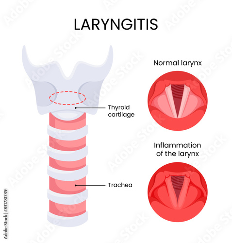 Diagram of laryngitis infection disease