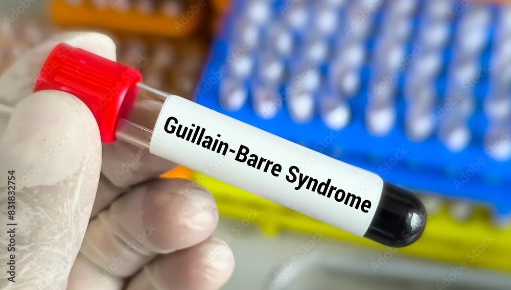 Obraz premium Guillain-Barre syndrome (GBS) test, a rare disorder where the body's immune system damages nerve.