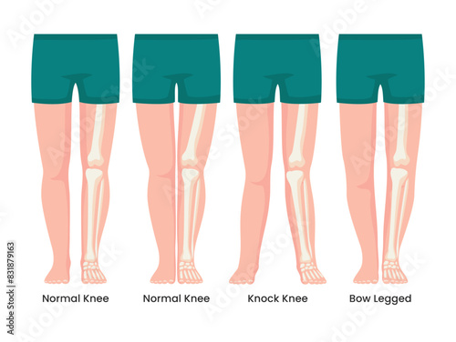 Set different types of Shapes of the legs. Normal and curved legs. Knock knees. Bowed legs. Genu valgum and genu varum. For advertising, medical, health care education publication poster or banner.