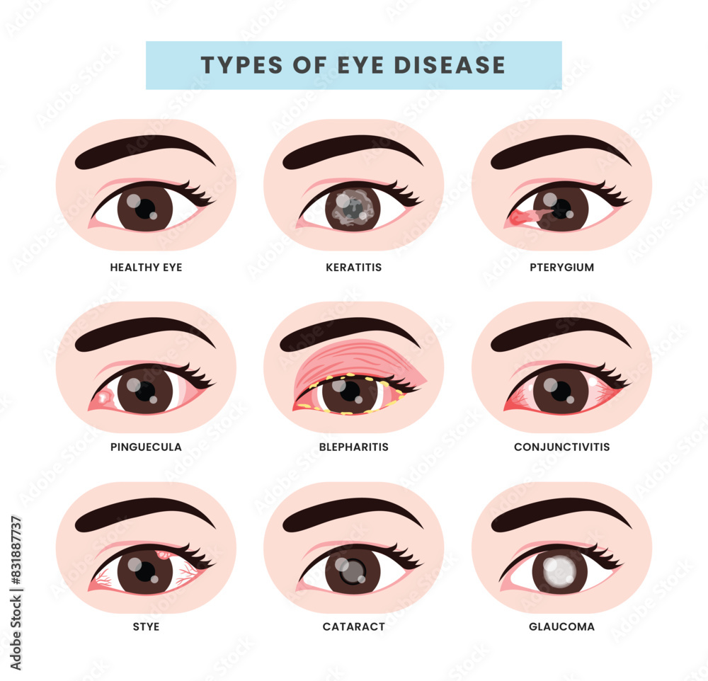 Set of different types of eye disease collection ophthalmology health