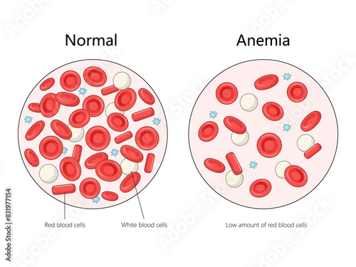 normal blood cells with anemic blood cells, highlighting the low amount of red blood cells in anemia diagram hand drawn schematic vector illustration. Medical science educational illustration