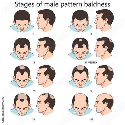 Stages of male pattern baldness, showing progressive hair loss from stage I to stage VII diagram hand drawn schematic vector illustration. Medical science educational illustration