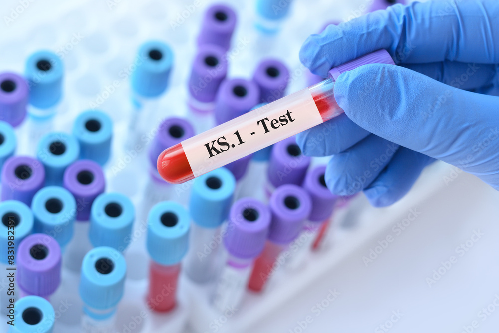 Fototapeta premium Doctor holding a test blood sample tube for the detection of the virus KS.1 on the background of medical test tubes. KS.1 one of the FliRT variants. Symptoms with FLiRT are the same as with omicron