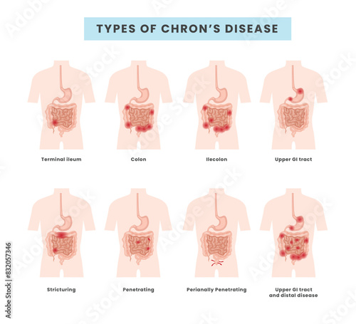Set of different types of Crohn's disease anatomy classification,  inflammatory bowel disease with terminal ileum, colon,ilecolon, upper gi tract, stricturing,medical infographic banner for education.