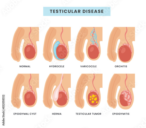 Different types of Testicular diseases types scheme male anatomy medical inflammation, Internal organ penis urologic health varicocele epididymitis orchitis spermatocele testis torsion hidrocele.