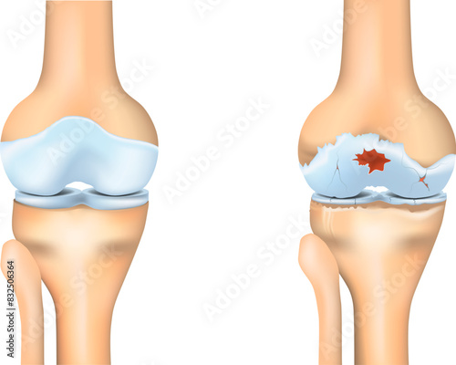 Knee osteoarthritis. Joint degeneration