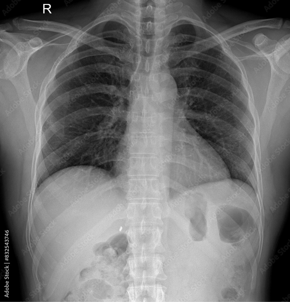 Professional X-ray Scan of Human Ribcage and Respiratory System Professional X-ray Scan of Human Ribcage and Respiratory System