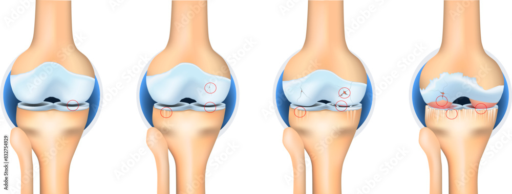 Stages of Osteoarthritis. knee joint anatomy Stock Vector | Adobe Stock