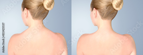 Botulinum toxin injection for trapezius muscle. Back of neck and shouledrs before and after botulinum toxin. photo