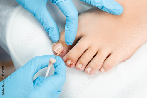 Close up podiatrist examines the nail and applies an antifungal treatment. 