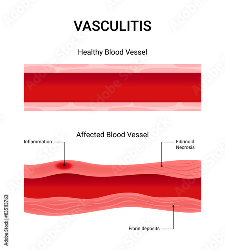 Vasculitis healthy blood vessels and those affected fibrinoid blood vessel inflammation photo