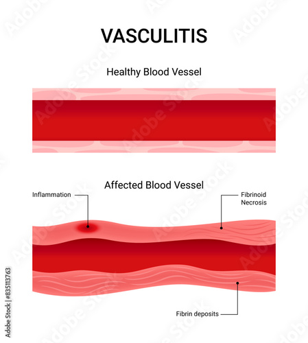 Vasculitis healthy blood vessels and those affected fibrinoid blood vessel inflammation