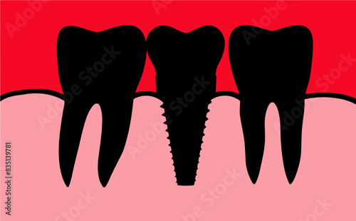 A dental implant, an implanted tooth is seen between two normal teeth in a logo type design that is a vector image.