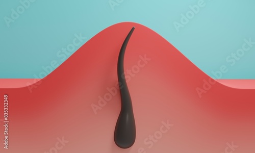 Ingrown hair with redness. 3d rendering