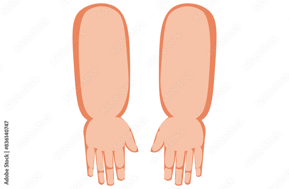 Angioedema is a rapid swelling of the deeper layers of the skin, often triggered by allergies. swelling the hand. It can be life-threatening if untreated,skin Angioedema is a rapid swelling of the deeper layers of the skin, often triggered by allergies. swelling the hand. It can be life-threatening if untreated,skin