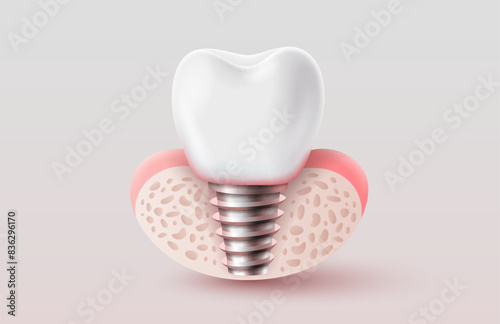 Dental implantation, tooth restoration, symbol on a white background. Vector illustration