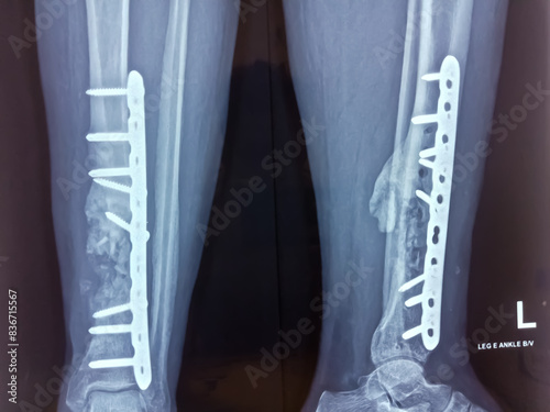 Foto X-ray of the leg