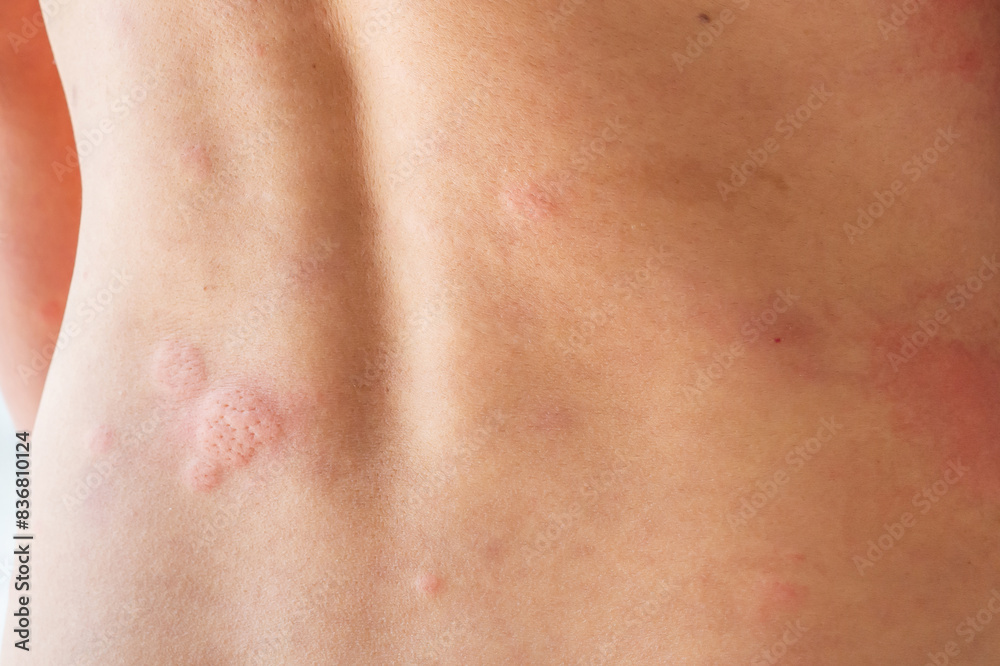 Young asian man itching and scratching on his back from allergic itchy dry skin eczema dermatitis insect bites Young asian man itching and scratching on his back from allergic itchy dry skin eczema dermatitis insect bites