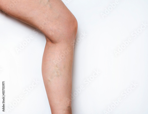 Varicose veins on a female leg. Female leg with varicose veins on white background