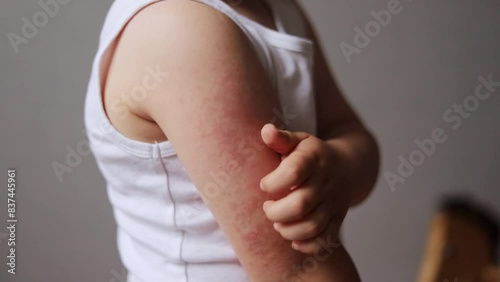 Child scratching arm with red rash