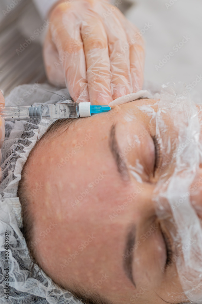 © Andrii Iemelianenko - Beauty anti-aging injections biorevitalization face mesotherapy. Cosmetologist doctor making needle hyaluronic injections syringe into skin of young woman girl. Lifting procedure therapy in clinic © Andrii Iemelianenko - Beauty anti-aging injections biorevitalization face mesotherapy. Cosmetologist doctor making needle hyaluronic injections syringe into skin of young woman girl. Lifting procedure therapy in clinic