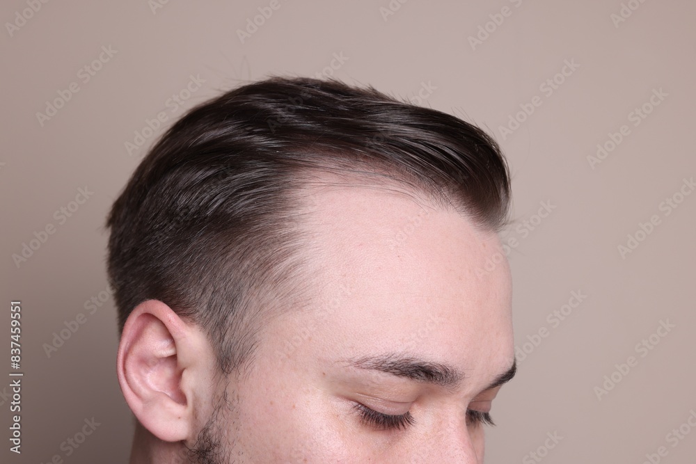 Obraz premium Baldness concept. Man with receding hairline on beige background, closeup