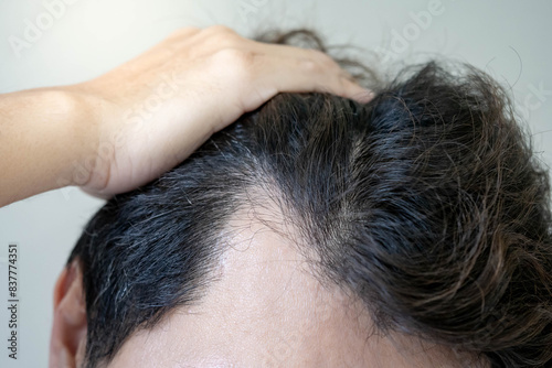 Canvas Print Hair loss or alopecia problem