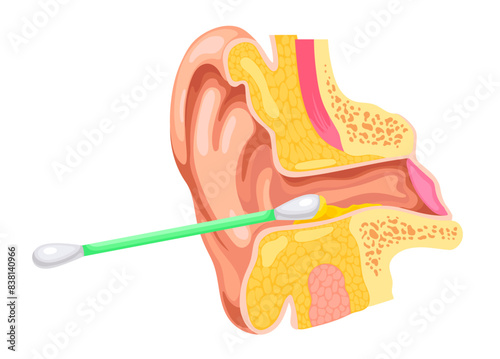 Ear canal cleaning. Ears clean earwax inside with cotton swab, otorhinolaryngology concept earing canal closeup anatomy dirty wax cerumen problem, ingenious vector illustration
