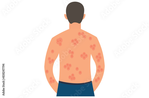 Autoimmune progesterone dermatitis,urticaria,Bullous pemphigoid,herpetiformis,Dermatomyositis,Epidermolysis bullosa acquisita,Gestational,Hidradenitis suppurativa,Lichen planus,Linear IgA,Psoriasis