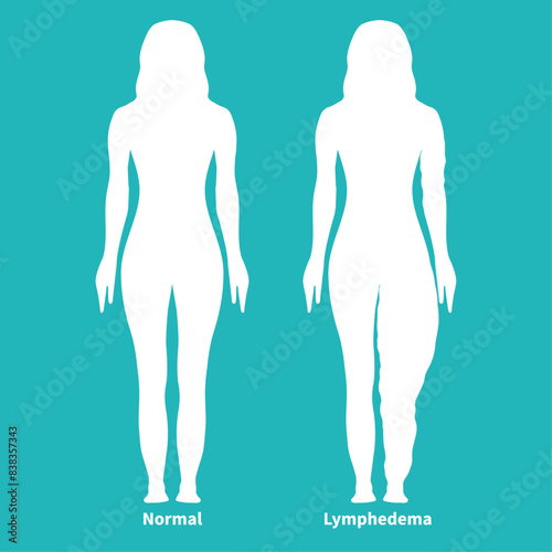 Teal Lymphedema Silhouette Illustration with Woman with Normal and Lipedema