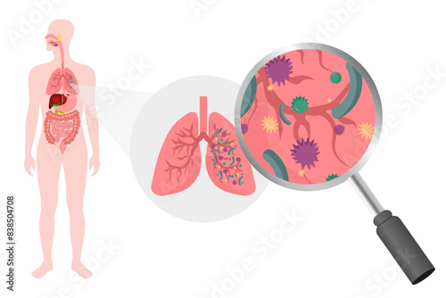 Lungs virus disease 