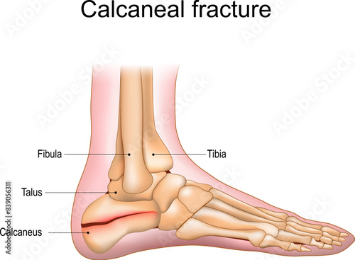 Calcaneal fracture. Trauma of Heel bone