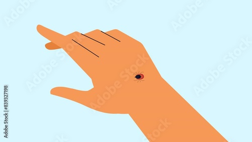 Hand and red insect tick bite animation. Tick in human hand biting with red area. 4K photo