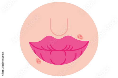 Autoimmune progesterone dermatitis,urticaria,Bullous pemphigoid,herpetiformis,Dermatomyositis,Epidermolysis bullosa acquisita,Gestational,Hidradenitis suppurativa,Lichen planus,Linear IgA,red