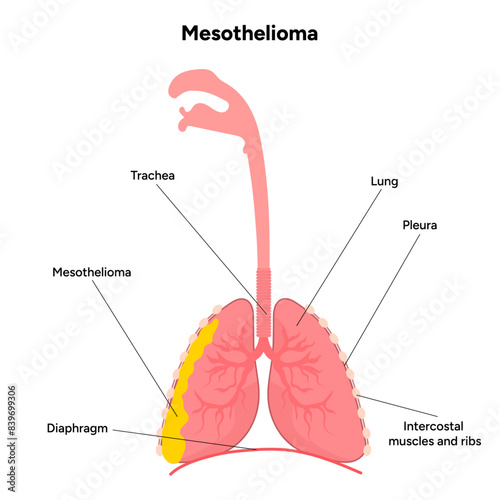 Mesothelioma lungs pulmonary system disease, lung problems