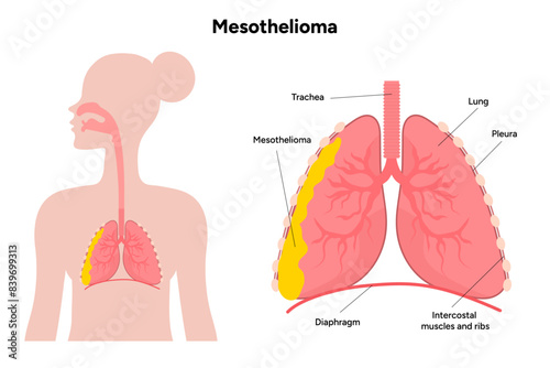 Mesothelioma disease, lung problems