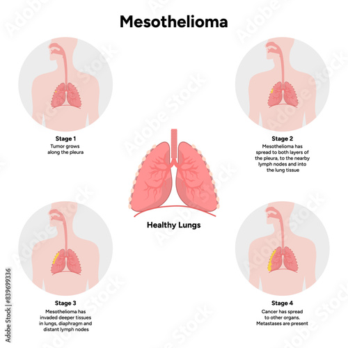 4 Stages of mesothelioma lung disease