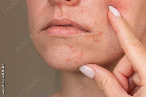 Closeup photo of face of a young Caucasian woman suffering from perioral dermatitis near the mouth. Skin problems. Dermatology. Skin diseases. Skin reaction. photo